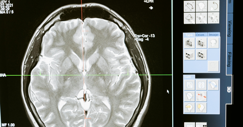 Factores de riesgo y biomarcadores de la enfermedad de Alzheimer